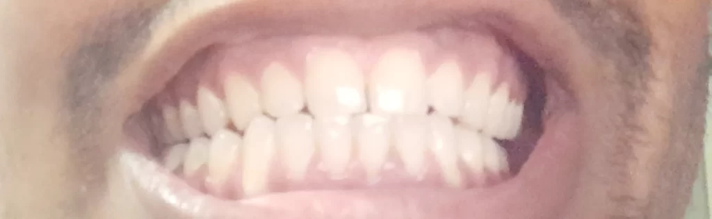 White teeth at home